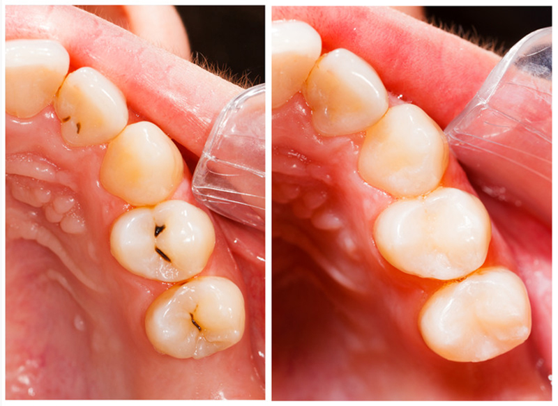 Fillings  Gresham, OR, 