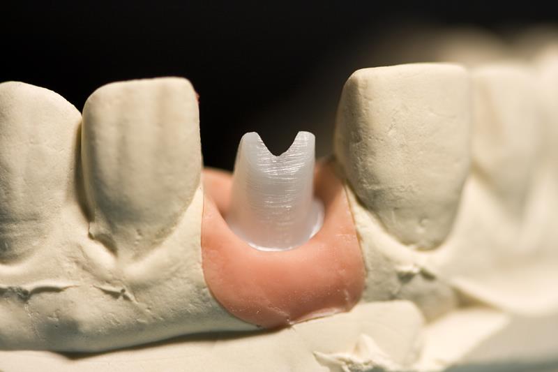 Implant Restoration  Gresham, OR, 